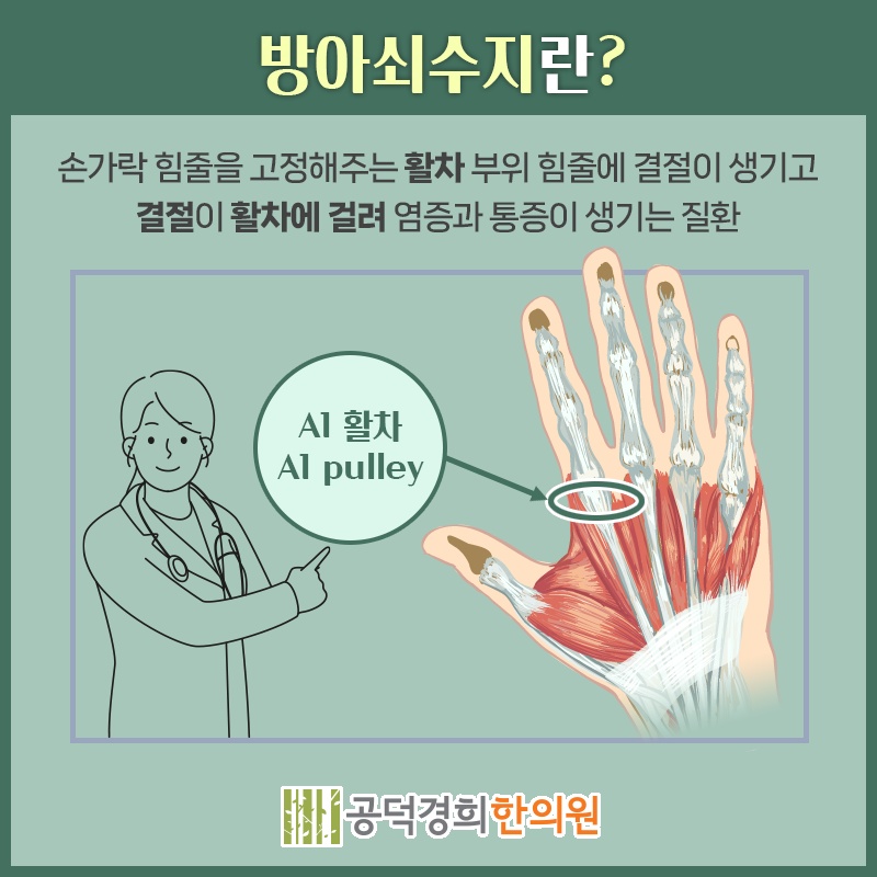 기상 후 손가락 통증이 두드러지는 방아쇠수지 증상 알아보기