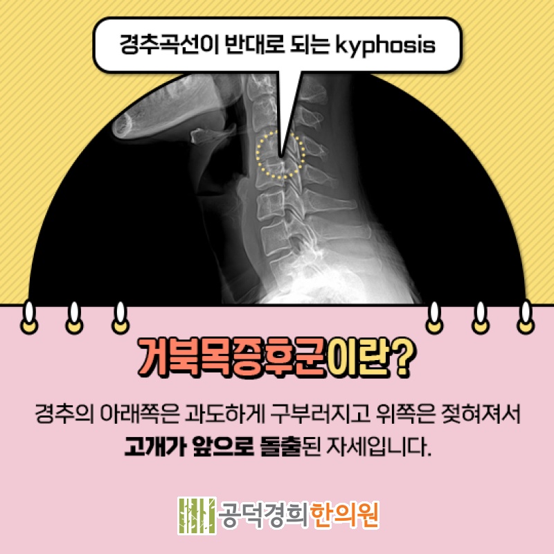 목이 앞으로 굽는 거북목증후군, 주요 신호 점검하기