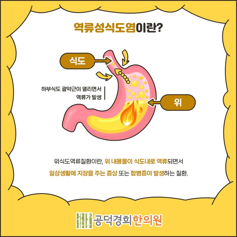 역류성식도염으로 반복되는 위산 신맛의 특징 알아보기