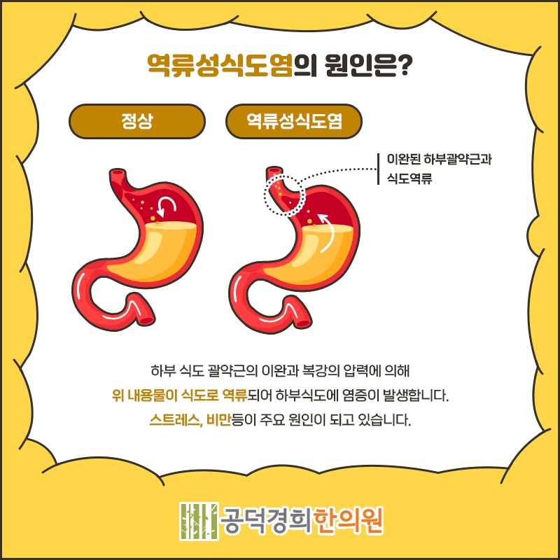역류성식도염으로 반복되는 위산 신맛의 특징 알아보기
