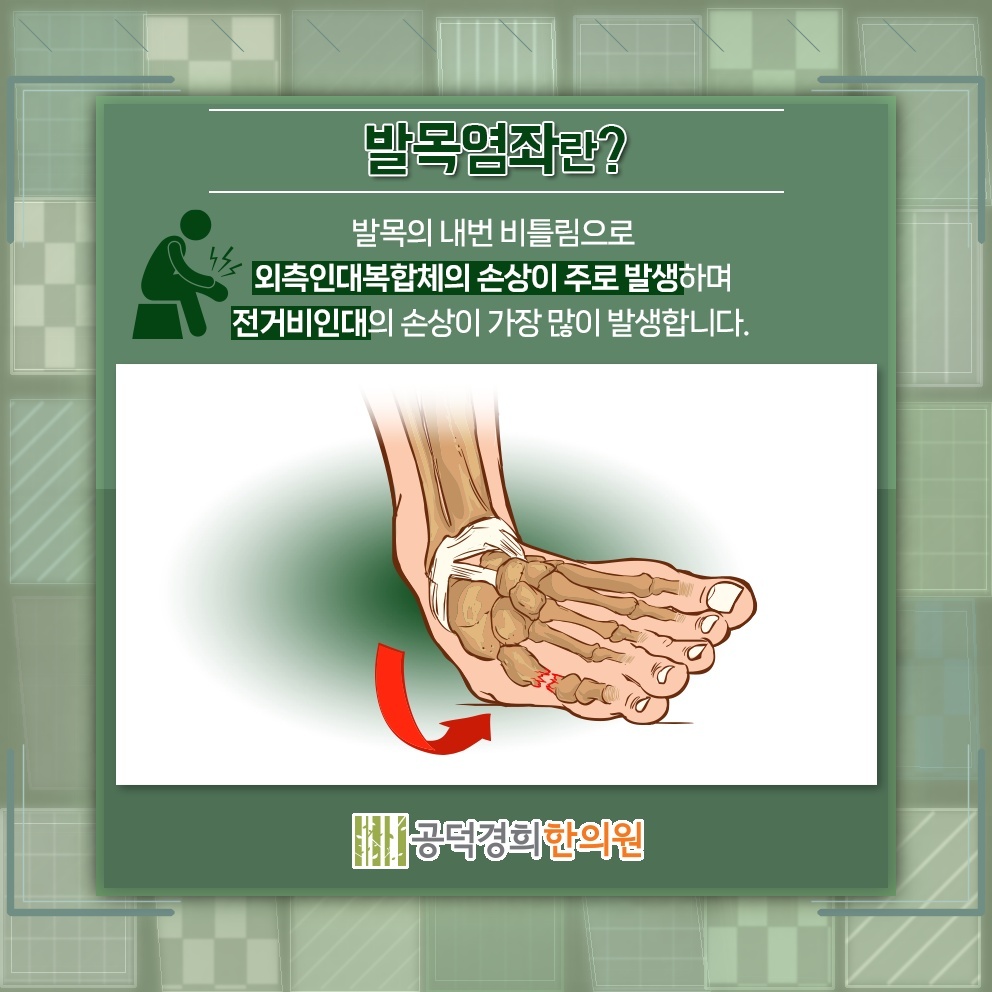 발목을 접질린 뒤 나타나는 염좌 증상과 회복 과정