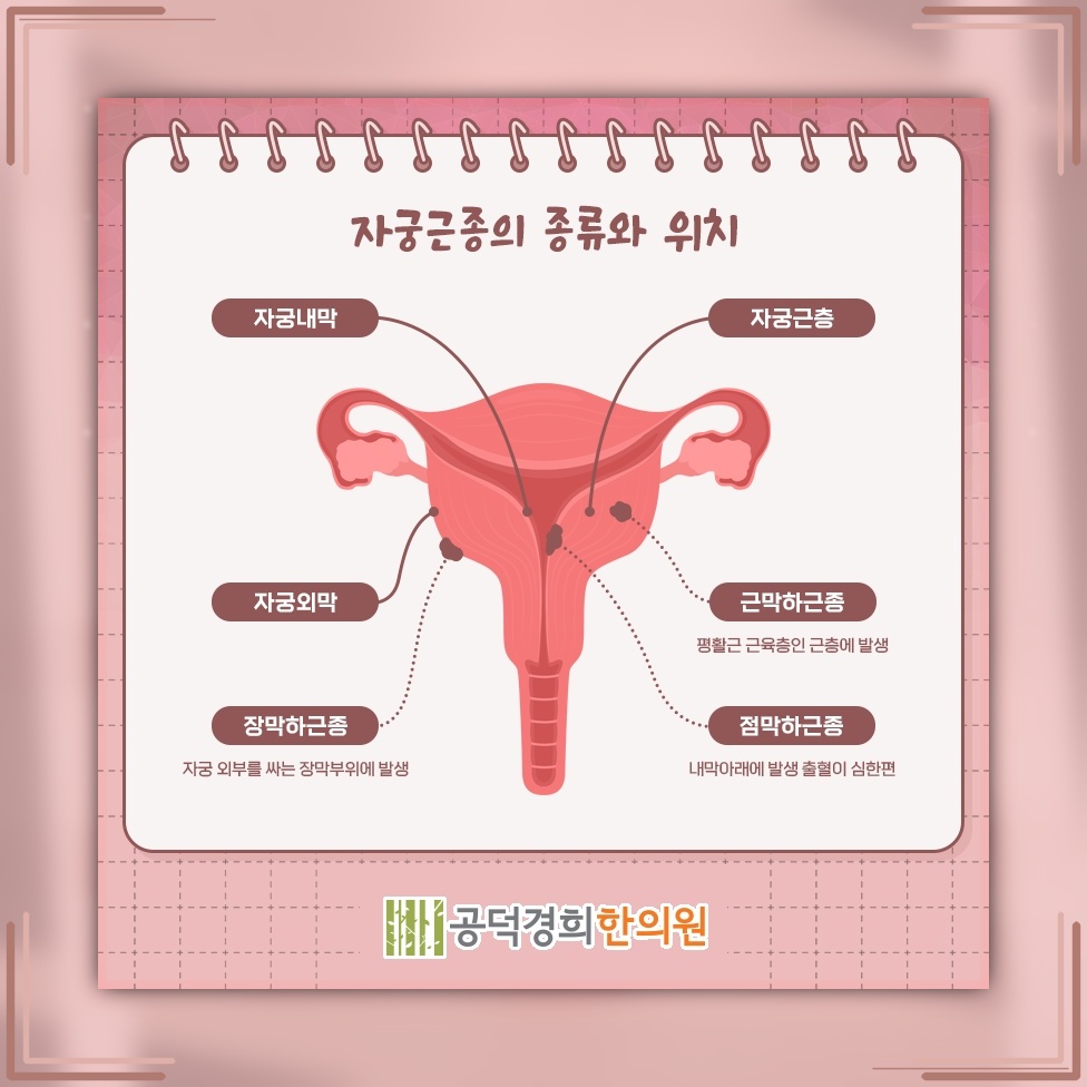 생리량 증가와 골반 통증으로 살펴보는 자궁근종