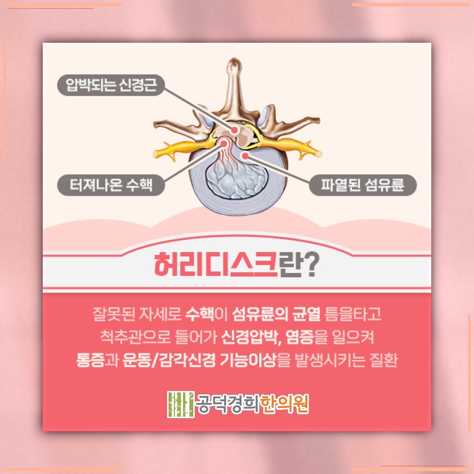 앉아 있을 때 허리디스크 부위의 척추 부담이 50% 늘어나는 이유